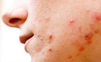 Can a Deep Cleansing Facial Help with Acne