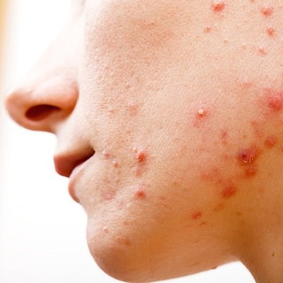 Can a Deep Cleansing Facial Help with Acne