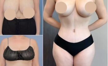 Tummy Tuck in Dubai