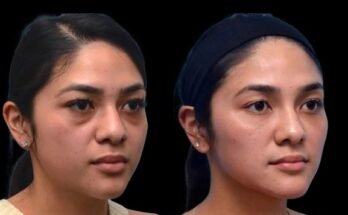 Dark Circles Treatment in Dubai