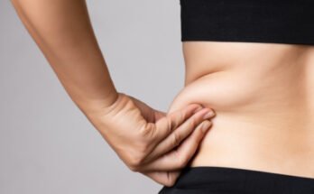 Liposuction in Dubai