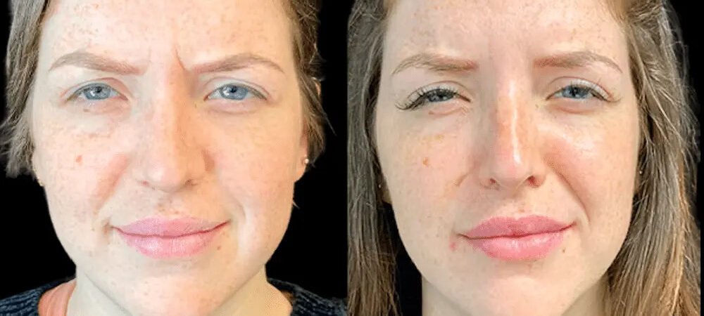 Best Doctors in Dubai Discuss Botox for Anti-Aging Solutions