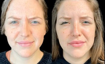 Best Plastic Surgeon in Dubai for Botox Cost Guidance