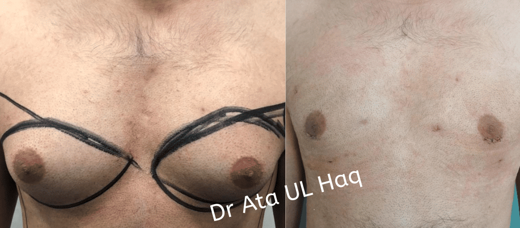 Gynecomastia in Lahore