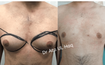 Gynecomastia in Lahore