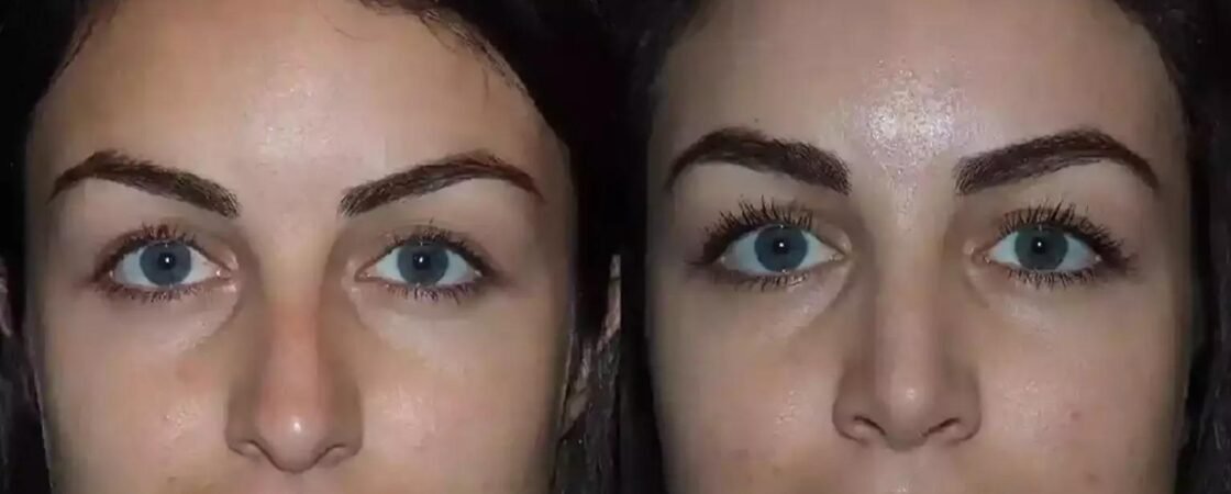 Septoplasty in Dubai