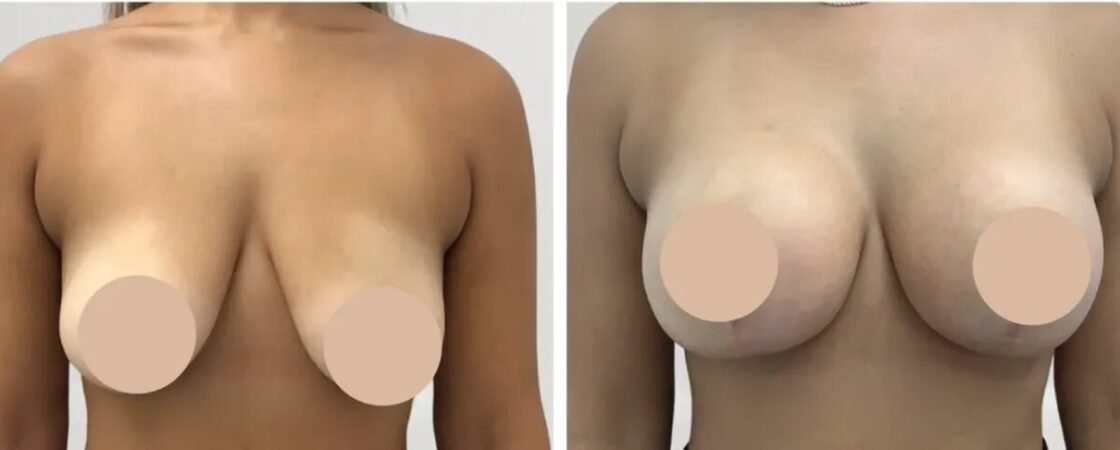 Breast Reduction in Dubai