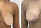 Breast Reduction in Dubai