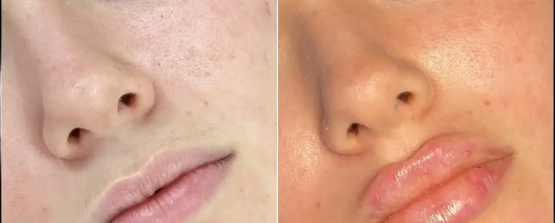 Dermal Fillers in Dubai