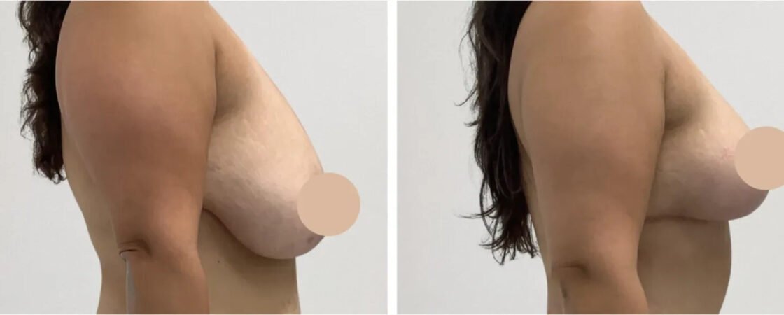 Breast Lift in Dubai