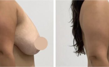 Breast Lift in Dubai