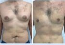 Gynecomastia in Dubai