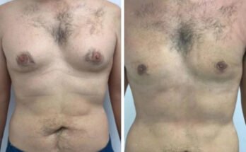 Gynecomastia in Dubai
