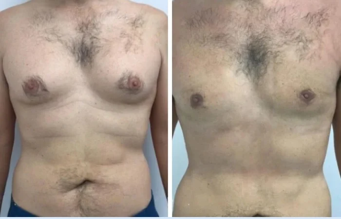 Gynecomastia in Dubai