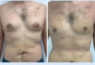 Gynecomastia in Dubai