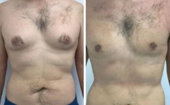 Gynecomastia in Dubai
