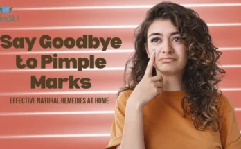 How to Get Rid of Pimple Marks at Home Naturally