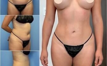 Body Contouring in Dubai