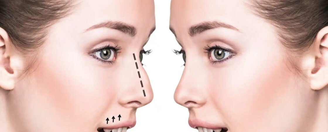 Rhinoplasty in Dubai
