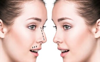 Rhinoplasty in Dubai