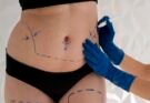 Tummy Tuck in Riyadh