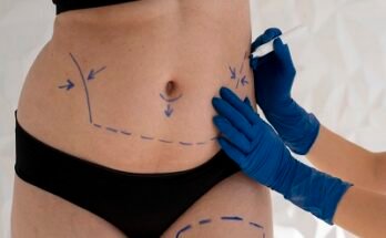 Tummy Tuck in Riyadh