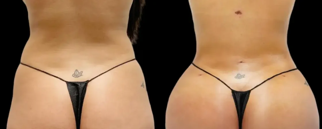 Best Butt Fat Transfer in Dubai