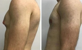 Gynecomastia surgery in Dubai