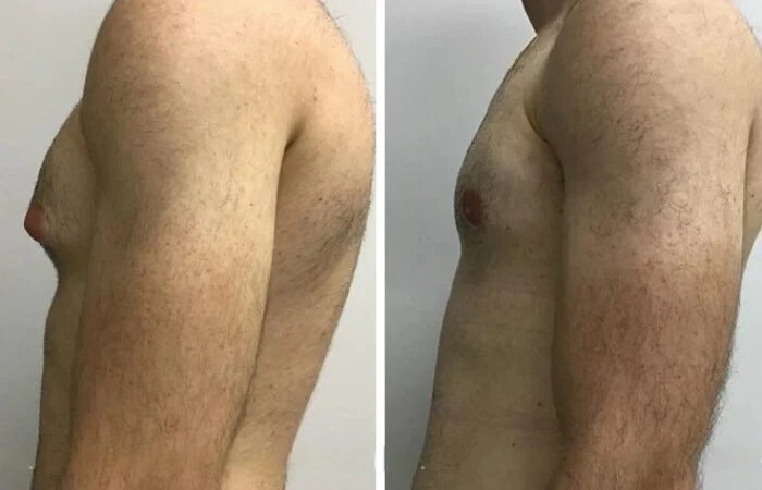 Gynecomastia surgery in Dubai