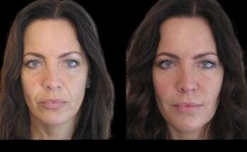 jawline fillers in Dubai