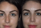 rhinoplasty in dubai