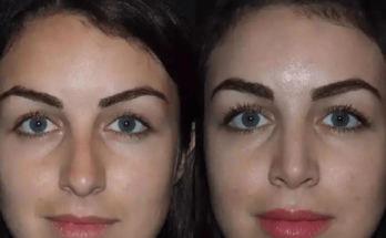 rhinoplasty in dubai