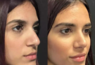 rhinoplasty in dubai
