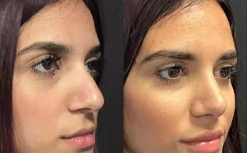 rhinoplasty in dubai