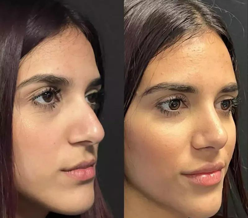 rhinoplasty in dubai