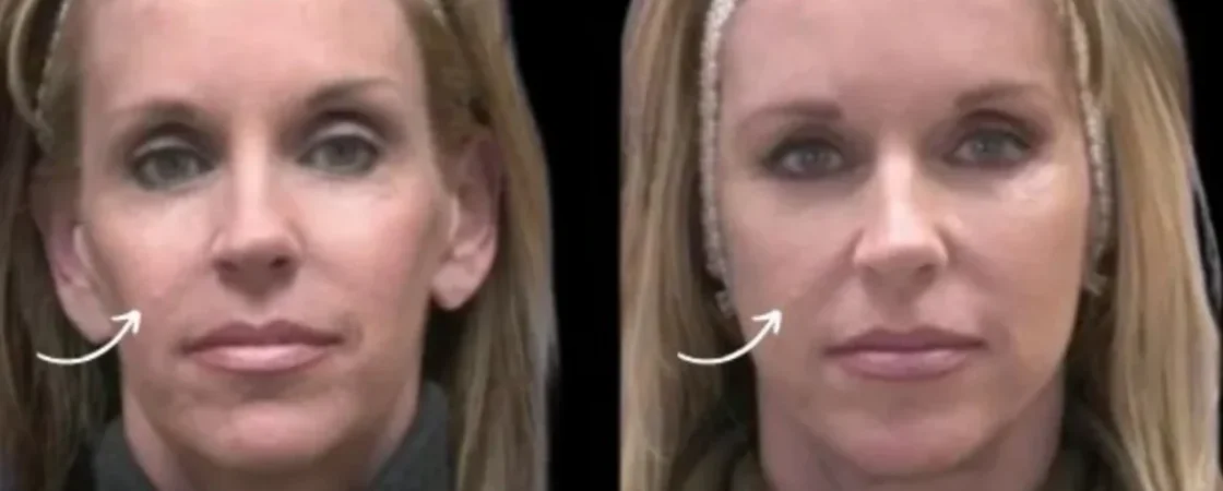 sculptra fillers in dubai