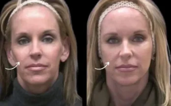 sculptra fillers in dubai