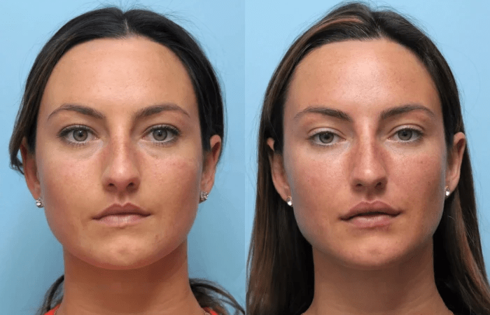 Thread lift in Dubai