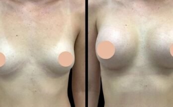 Breast augmentation in dubai