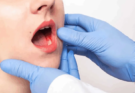 Modern Approaches to Leukoplakia Treatment in Oral Health Care
