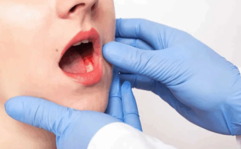 Modern Approaches to Leukoplakia Treatment in Oral Health Care