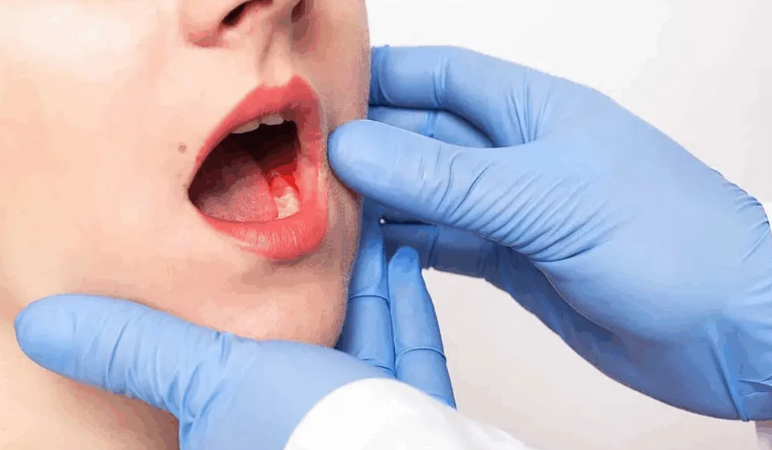Modern Approaches to Leukoplakia Treatment in Oral Health Care